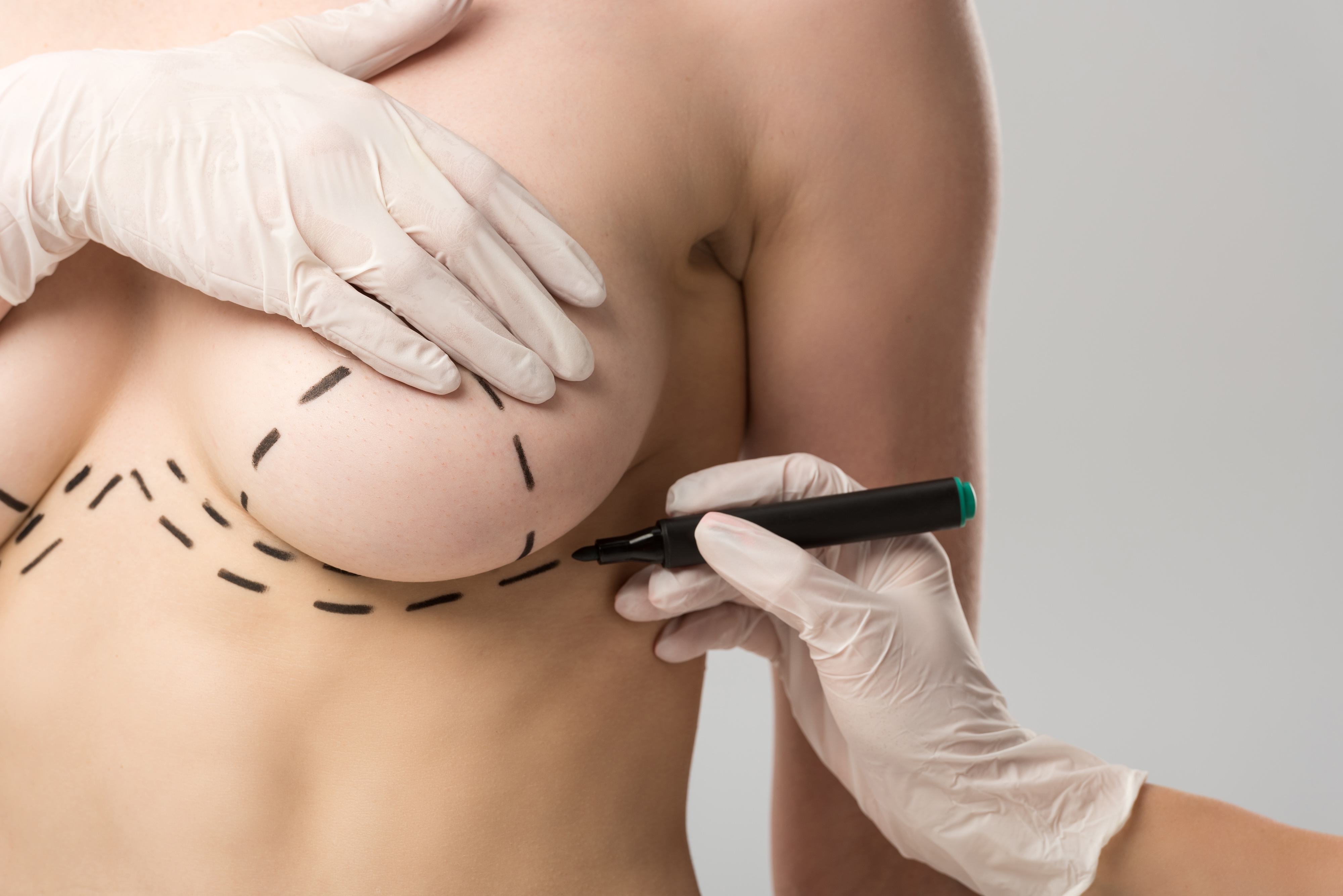 Double Bubble Breast Deformity Surgery on a woman