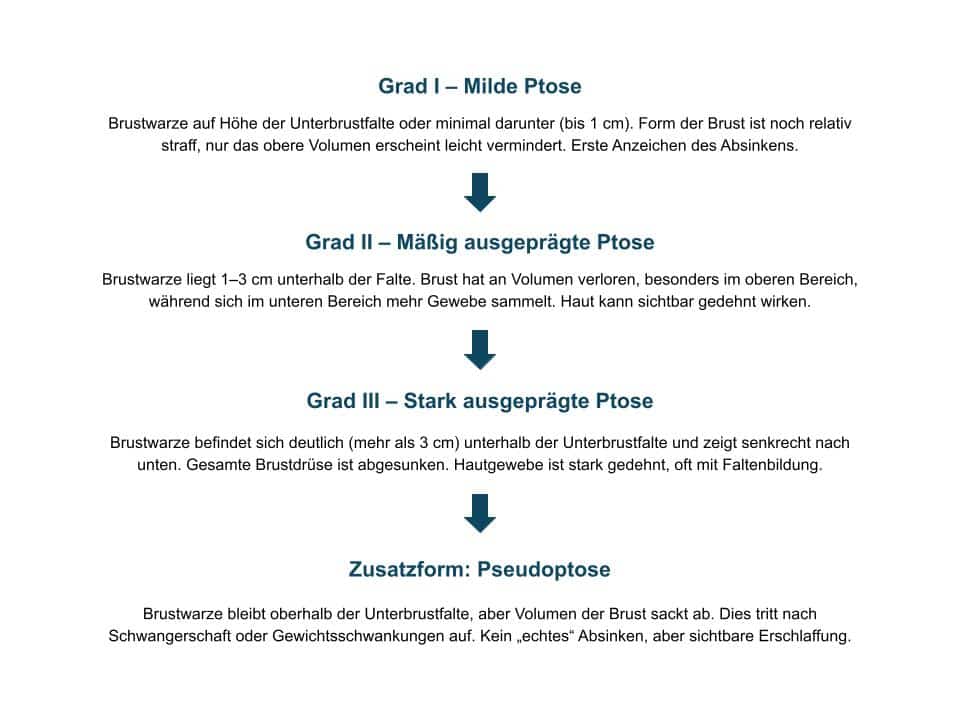 Hängebrüste - Grade; Übersicht