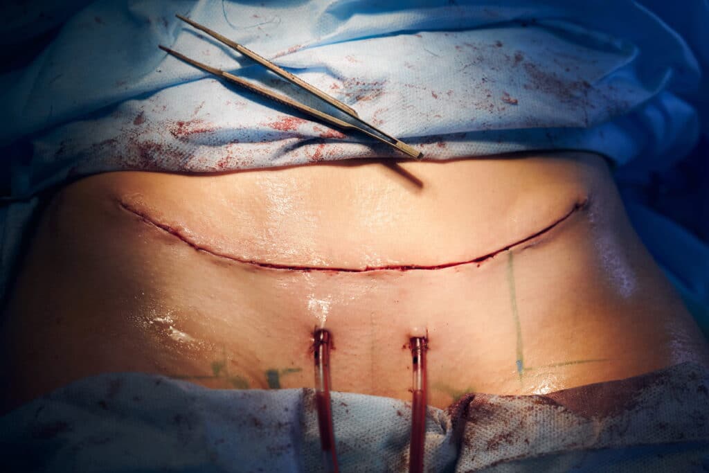 Close up of female belly with suture line after tummy tuck surgery and forceps.